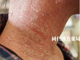 アトピー 治療前 同仁漢方薬局